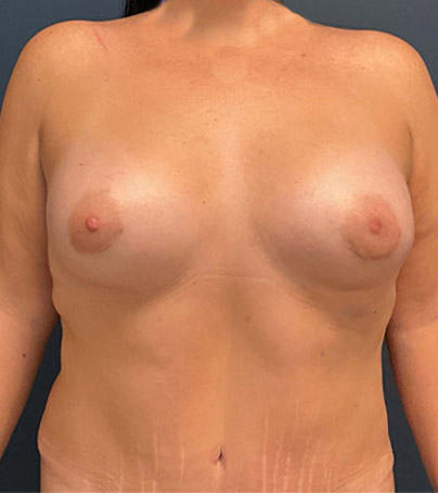 Breast Augmentation case #7173