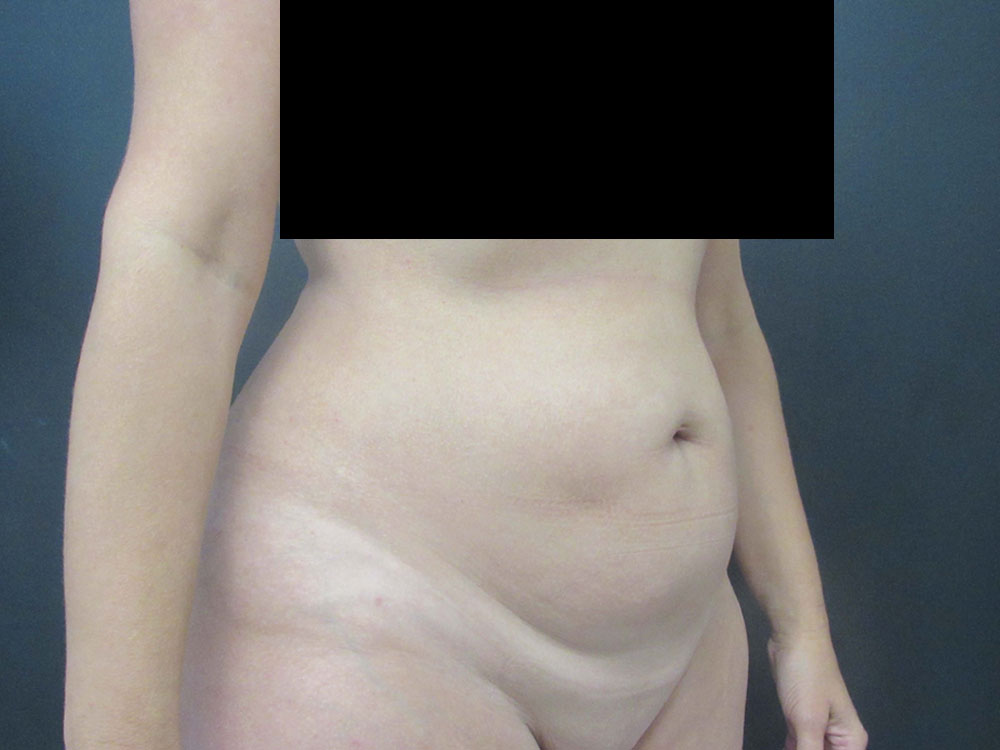 Tummy Tuck case #7190