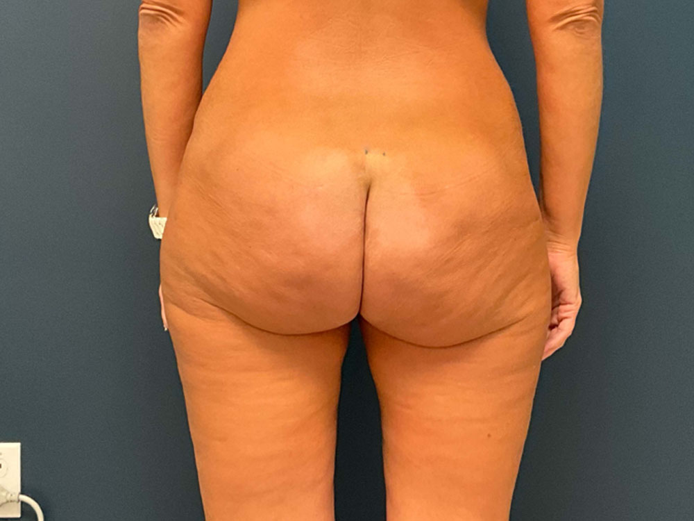 Tummy Tuck case #7190