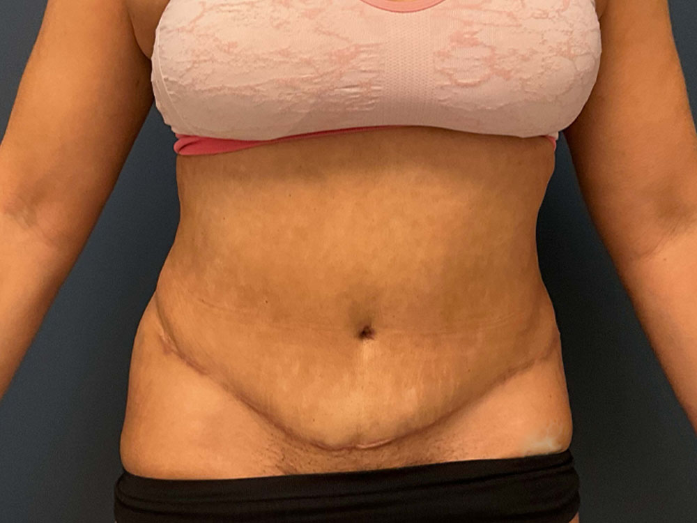 Tummy Tuck case #7485