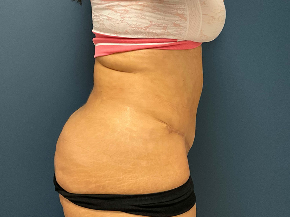 Tummy Tuck case #7485