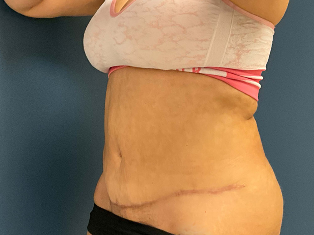 Tummy Tuck case #7485