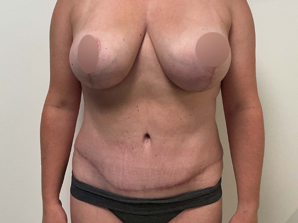 Tummy Tuck case #7498