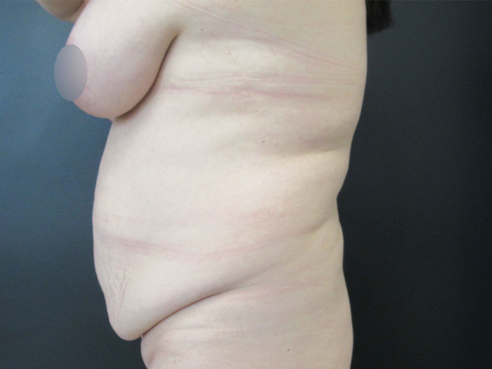 Tummy Tuck case #7498