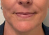 Chin Liposuction case #7769