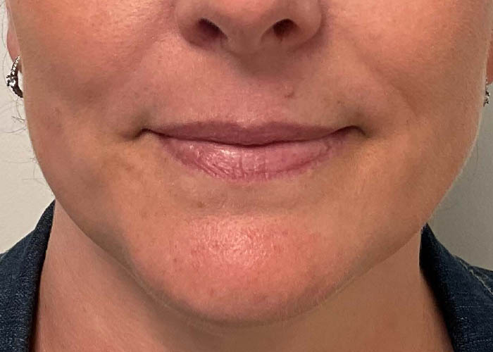 Chin Liposuction case #7769