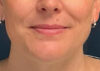 Chin Liposuction case #7769