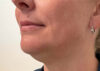 Chin Liposuction case #7769