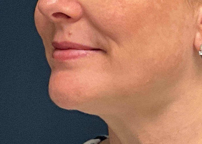 Chin Liposuction case #7769