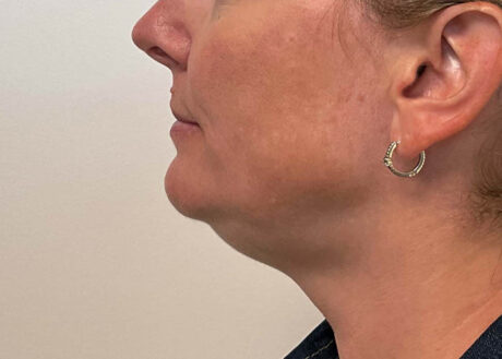 Chin Liposuction case #7769