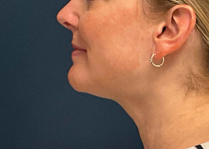 Chin Liposuction case #7769