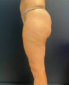 Liposuction case #9697