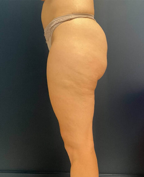 Liposuction case #9697