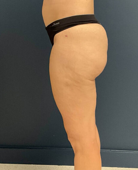 Liposuction case #9697