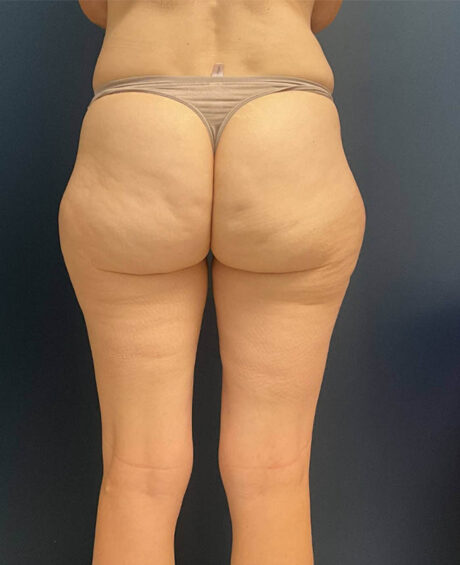 Liposuction case #9697