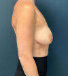 Breast Augmentation case #11262