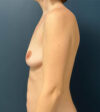 Breast Augmentation case #11217