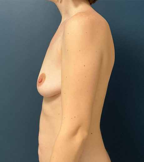 Breast Augmentation case #11217