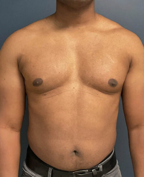 Gynecomastia case #11431