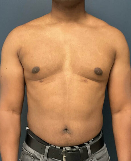 Gynecomastia case #11431