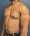 Gynecomastia case #11431