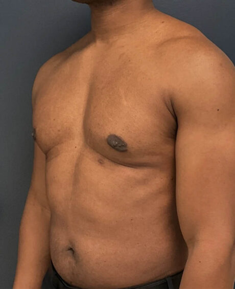 Gynecomastia case #11431