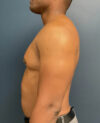 Gynecomastia case #11431