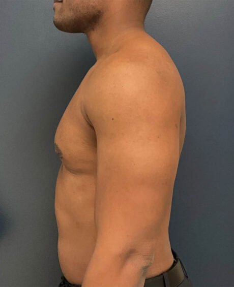 Gynecomastia case #11431