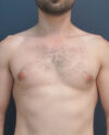 Gynecomastia case #11423