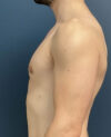 Gynecomastia case #11423