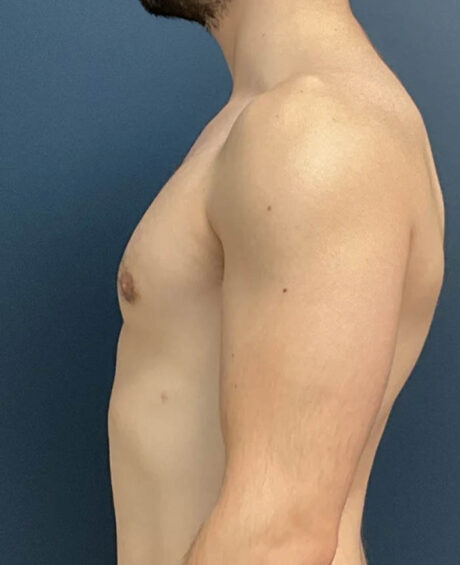 Gynecomastia case #11423