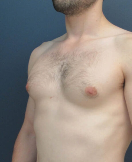 Gynecomastia case #11423