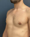 Gynecomastia case #11423