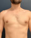 Gynecomastia case #11423